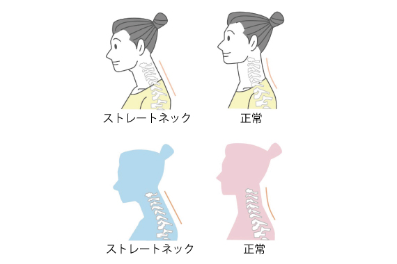 ストレートネックの画像